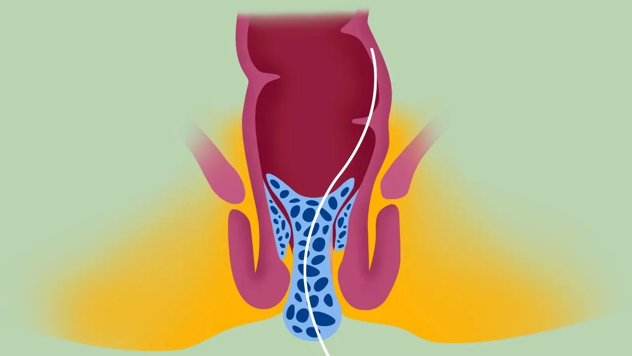 Transanale Offene Hämorrhoidopexie – Videostandbild 2 von 5