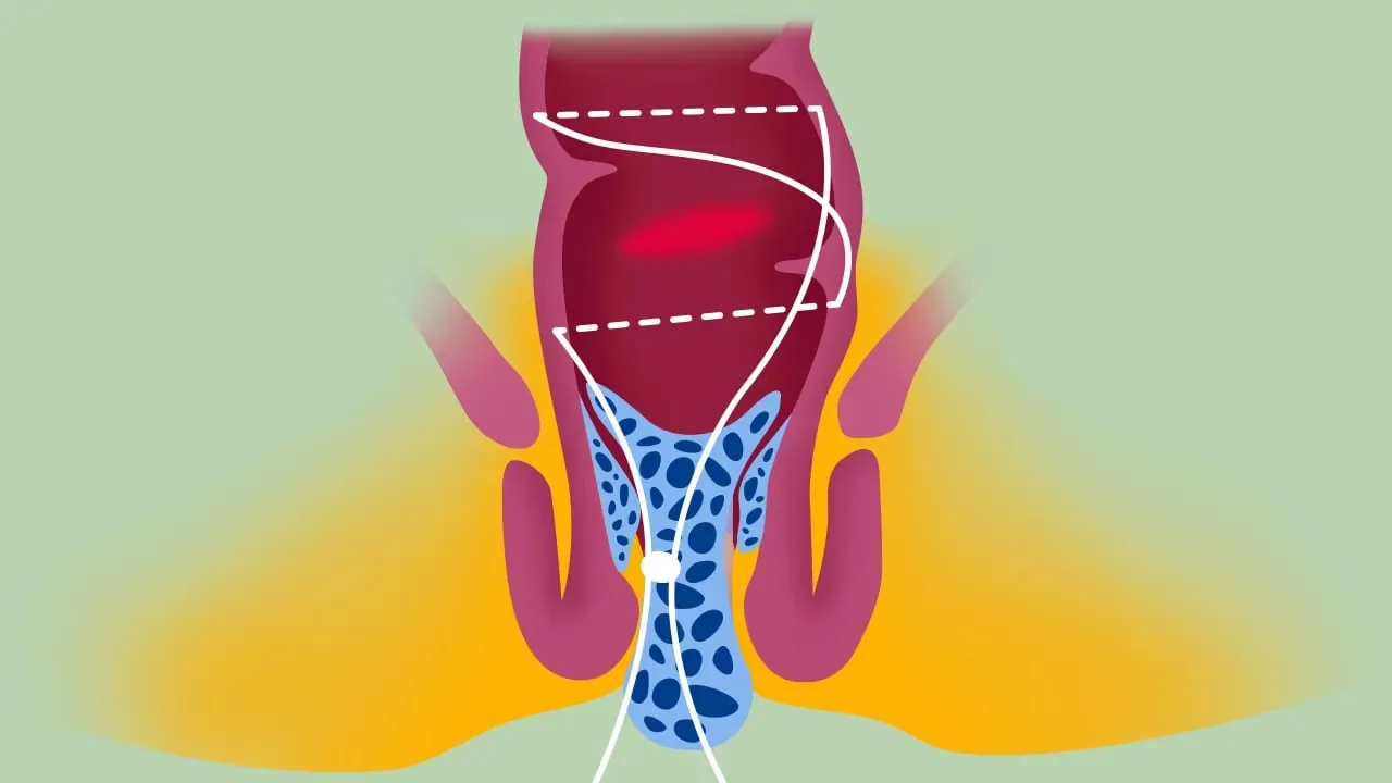 Transanale Offene Hämorrhoidopexie – Videostandbild 4 von 5